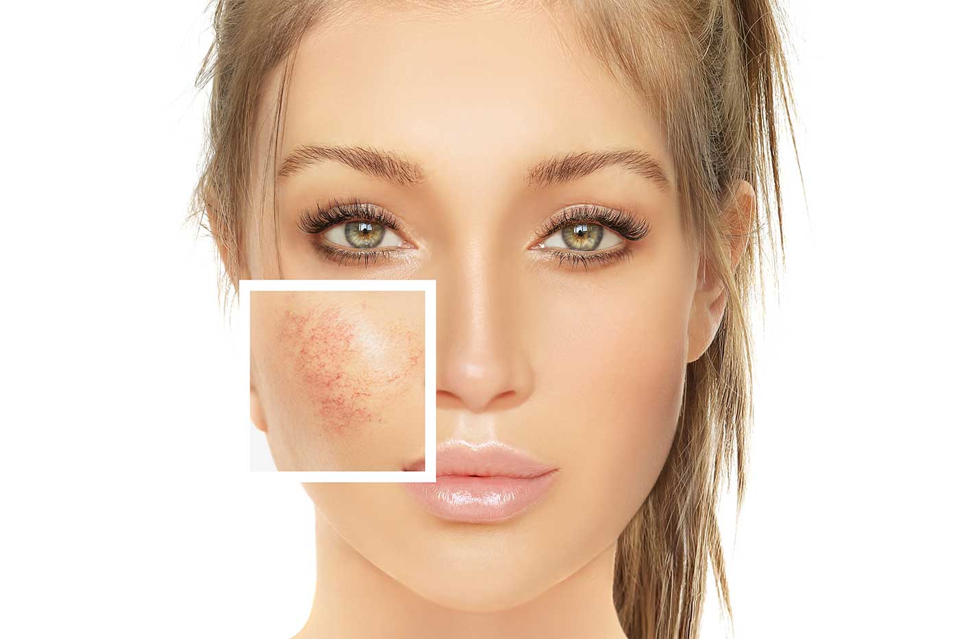 Laser vasculaire candela : Vaisseaux disgracieux corps et visage